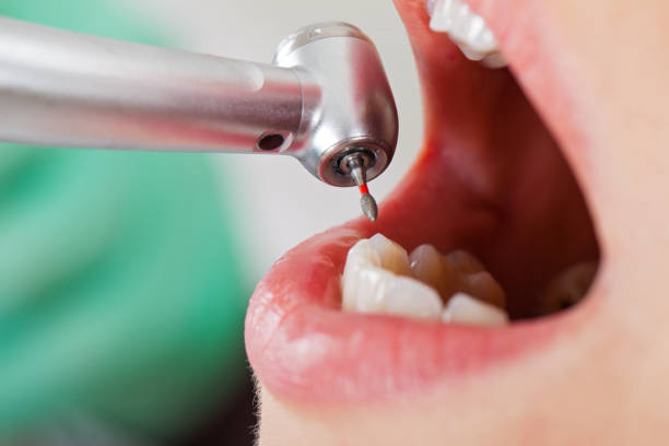 Best Emergency Dental Care for Broken or Chipped Teeth in Martha Lake, WA